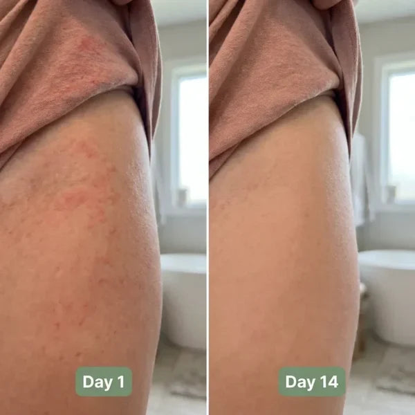 💚 LAST DAY BUY 1 GET 1 FREE✨Intertrigo Relief Cream treats 99% of skin fold rashes from the first application Intertrigo Cream🛒