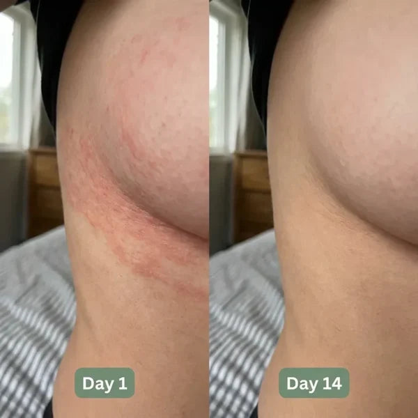 💚 LAST DAY BUY 1 GET 1 FREE✨Intertrigo Relief Cream treats 99% of skin fold rashes from the first application Intertrigo Cream🛒