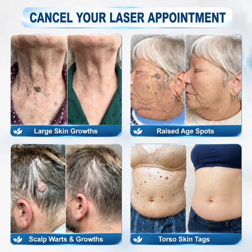 7-Day Skin Tag & Spot Eraser Painless & Scar-Free Advanced Skin Renewal Roller Pen