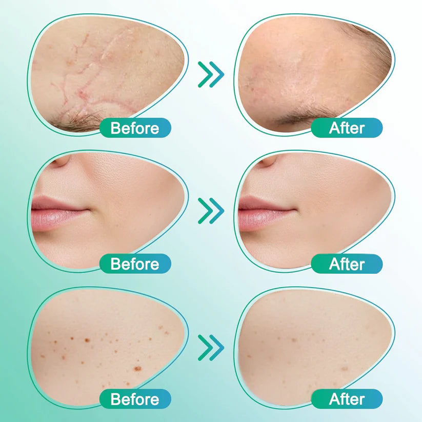 CareBreeze 3-in-1ScarRemoval Microneedle Care Patch
