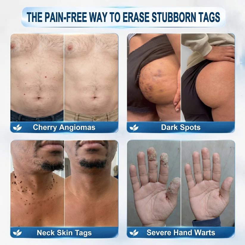 7-Day Skin Tag & Spot Eraser Painless & Scar-Free Advanced Skin Renewal Roller Pen