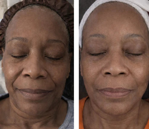Navaro™ Collagen Peptide Lifting Ampoule