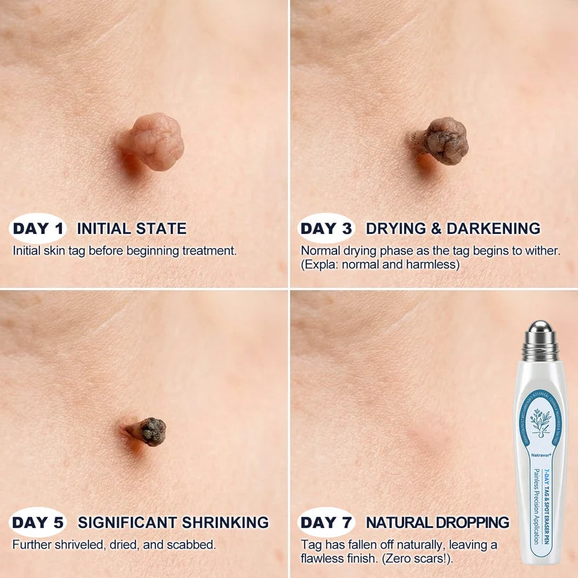 7-Day Skin Tag & Spot Eraser Painless & Scar-Free Advanced Skin Renewal Roller Pen